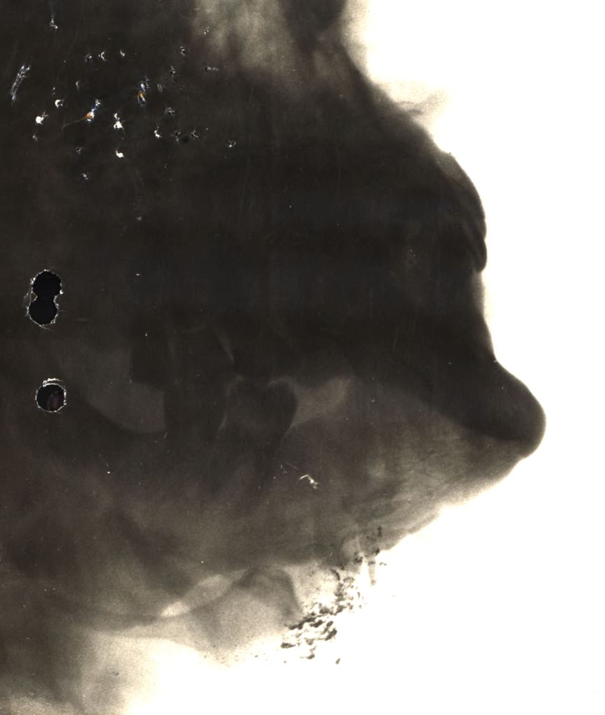 The X-ray showing Private Laramie's broken jaw, August 1918